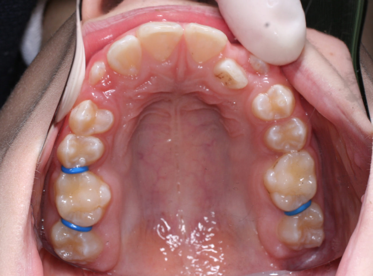 Spacers Dr Pascal Carrière